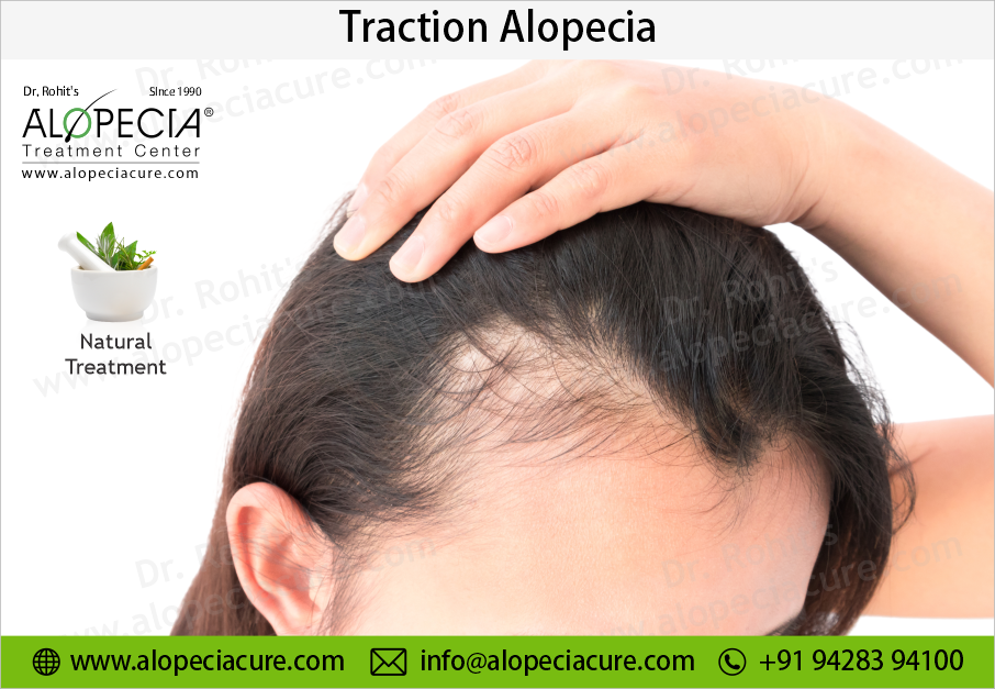 traction alopecia
